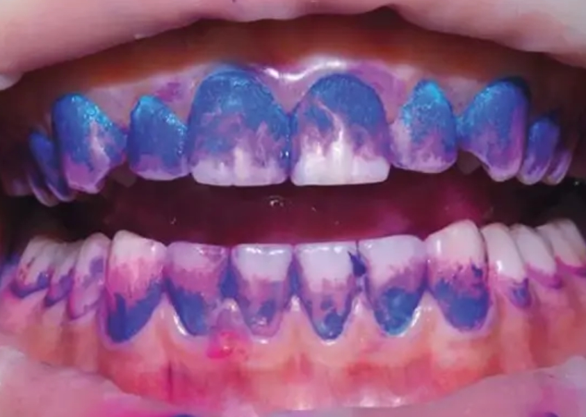 染め出しで目に見える状態にしたバイオフィルム